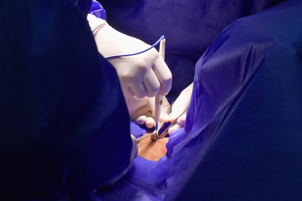 Hernia inguinal abierta con malla